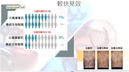 新一代生物制剂：银屑病患者疗效可达“PASI 100”！