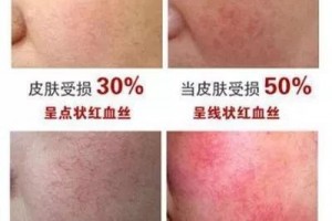 灵敏肌怎么完全修正好90%的人都不知道的灵敏肌修正办法